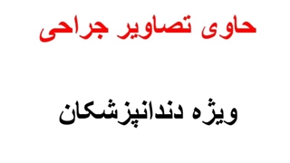 جراحی پیشرفته لیفت لثه توسط دکتر بهمن پوراقدم02122220000
