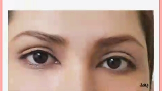 هزینه عمل جراحی افتادگی پلک (بلفاروپلاستی) چقدر است؟