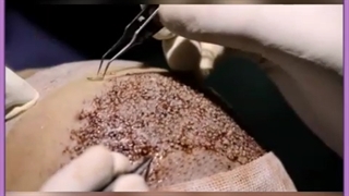 کاشت مو به روش BHT