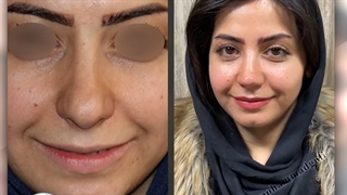 قبل و بعد جراحی زیبایی بینی | دکتر گلی