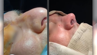 نتیجه جراحی زیبایی بینی بلافاصله پس از عمل | دکتر گلی
