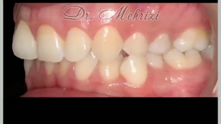 حرکت دندانها در ارتودنسی | دکتر احسان ابوئی مهریزی