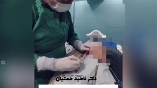 تزریق چربی به خط خنده