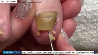 آموزش پدیکور و مانیکور-آموزش پدیکور-آموزش پدیکور پاهای آسیب دیده