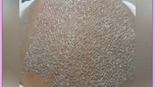 هزینه ، معایب و مزایای کاشت مو به روش سوپر ترکیبی