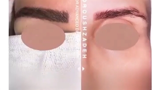 کاشت ابرو با نتیجه ای بی نظیر