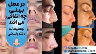 در عمل بینی چه اتفاقی میافتد؟ (توضیحات دکتر راسخی)