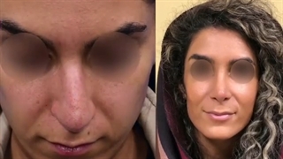 فیلم جراحی بینی