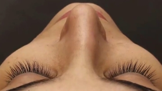 جراحی رینوپلاستی