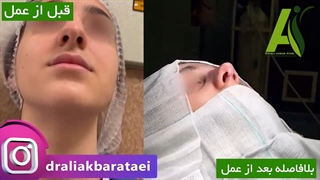 جراحی زیبایی بینی