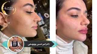 تزریق ژل لب، گونه و چانه