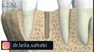 فیلم واقعی ایمپلنت دندان