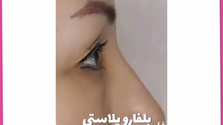 هزینه عمل جراحی افتادگی پلک (بلفاروپلاستی) چقدر است؟