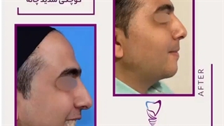 نمونه های جراحی چانه