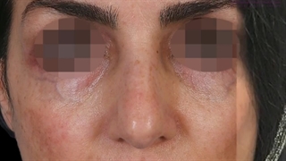 چند ماه بعد از جراحی زیبایی بینی