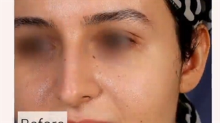 فیلم قبل و بعد از عمل بینی