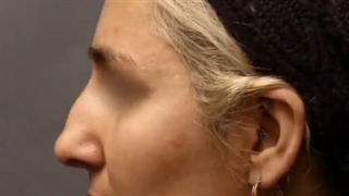 قبل و بعد از جراحی بینی