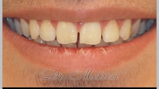 بستن فاصله دندان ها | دکتر احسان ابوئی مهریزی