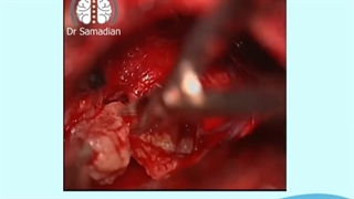 عمل جراحی تومور سی پی انگل