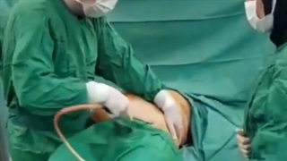 ابدومینوپلاستی به همراه لیپوساکشن