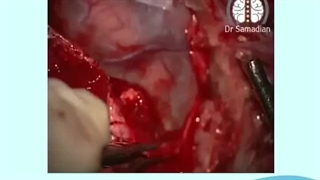 عمل جراحی مننژیوم منطقه کرتکس حرکتی سمت راست با تهاجم به بافت مغز و جمجمه