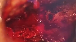 جراحی دیسک کمر