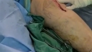 جراحی به روش MIS