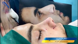بلافاصله بعد از جراحی بینی مردانه