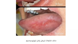 حذف ضایعات دهان و زبان با کمک دستگاه پلاسماالکتروسرجیکال