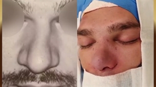 عمل بینی گوشتی با انحراف شدید