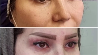 بلفاروپلاستی