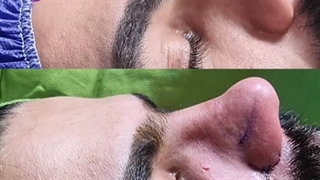 عمل بینی مردانه
