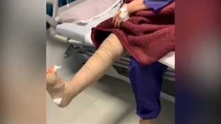 بیمار ۵۶ ساله یک روز بعد از عمل یونی کندیلار زانو