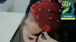 بررسی عملکرد مغز با استفاده از نقشه مغزی