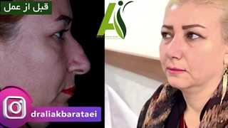 جراحی زیبایی بینی