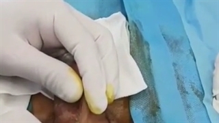 عمل ترمیم فیستول مجرای ادراری