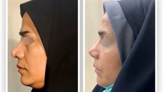 جراحی زیبایی بینی توسط دکتر پژمان سرشار زاده