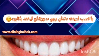 لمینت دندان در کلینیک دندانپزشکی قلهک