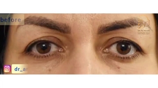 فیلم واقعی از عمل بلفاروپلاستی