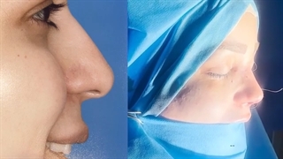 جراحی بینی طبیعی