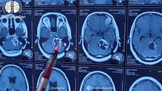 عمل جراحی تومور سی پی انگل