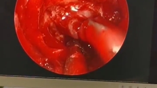 جراحی ادنومای هیپوفیز