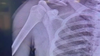 شکستگی خرد شده کلاویکل فیکساسیون با پلاک