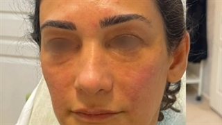 تزریق فیلر زیرچشم و میدفیس