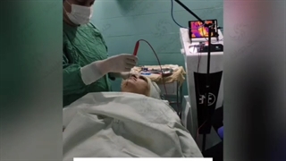 جراحی غبغب با دستگاه ENDO RF