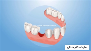 فیلم کشیدن دندان با جراحی و بدون جراحی
