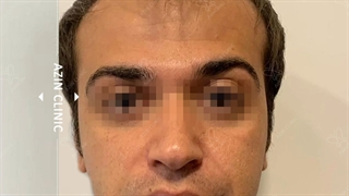 خط رویش طبیعی کاشت مو