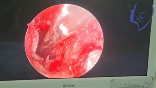 جراحی آندوسکوپی گوش برای ترمیم پرده