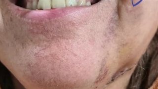 جراحی توده عوده کرده در صورت