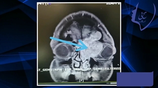 جراحی تومور بدخیم وسیع بینی و سینوس و چشم و قاعده جمجمه